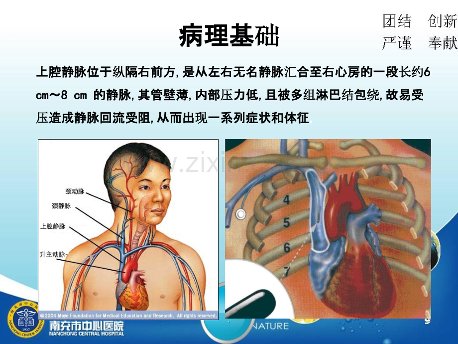 上腔静脉综合征护理查房.ppt_第3页