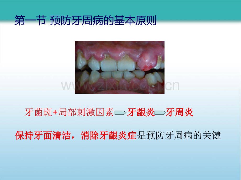 牙周病的预防和疗效维护.pptx_第2页