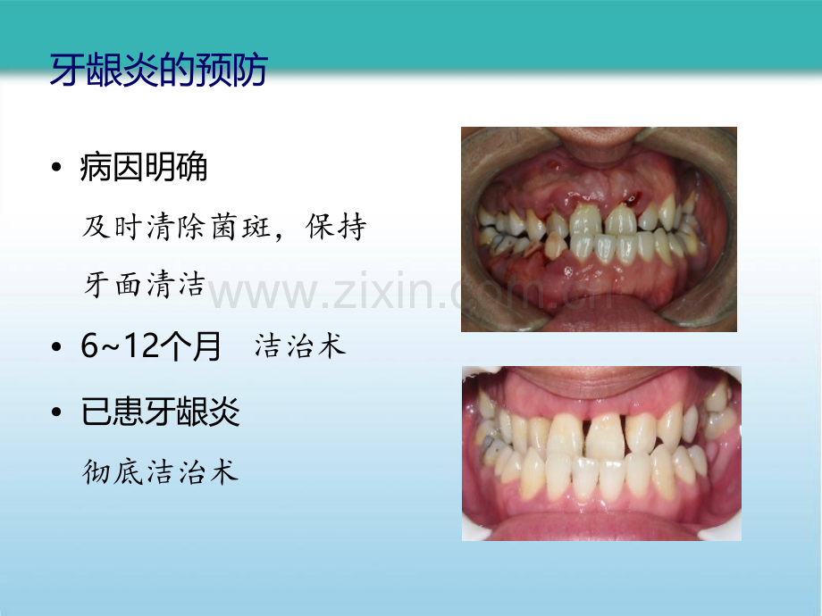 牙周病的预防和疗效维护.pptx_第3页