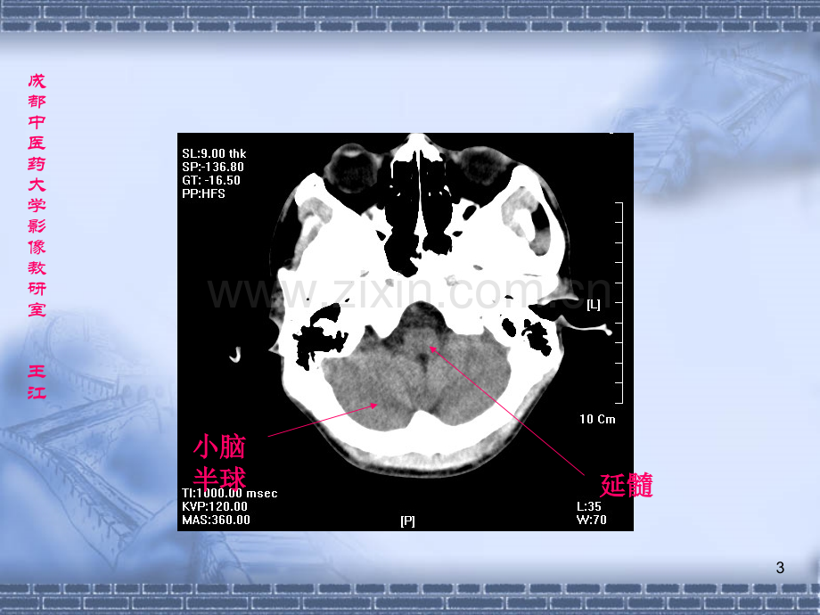 颅脑CT影像学-.ppt_第3页