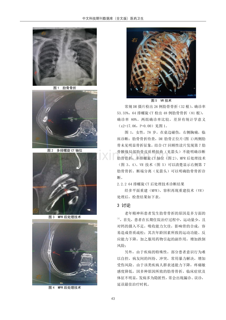 多排螺旋CT_DR摄片在老年精神病患者发生肋骨骨折中的诊断价值比较.pdf_第3页