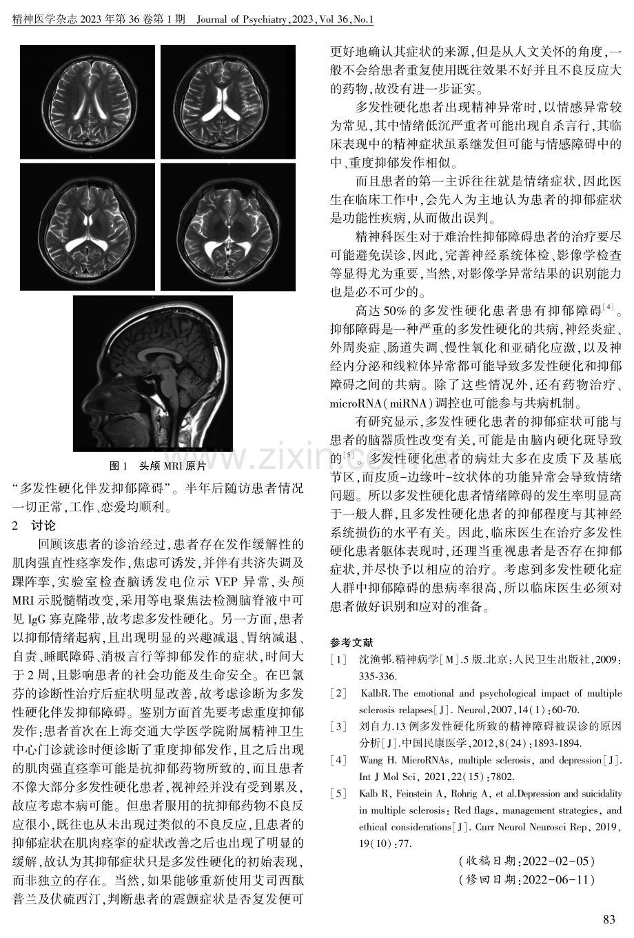 多发性硬化伴发抑郁障碍一例.pdf_第2页