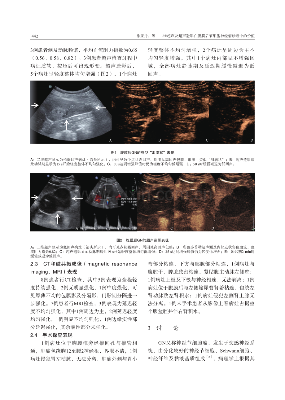 二维超声及超声造影在腹膜后节细胞神经瘤诊断中的价值.pdf_第3页