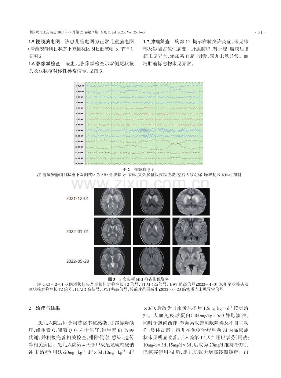 儿童抗γ-氨基丁酸B受体脑炎1例并文献复习.pdf_第3页