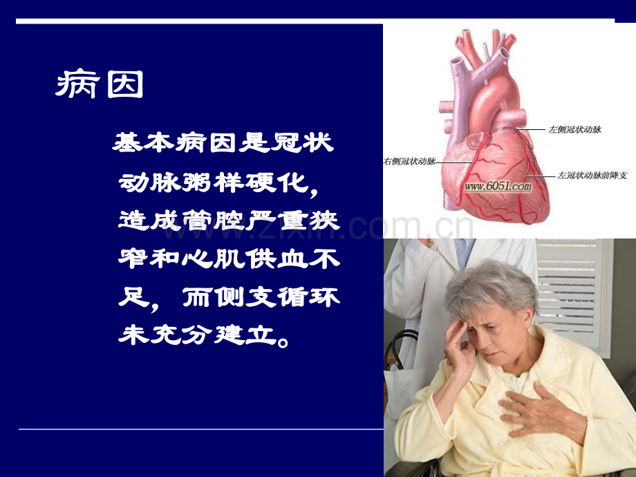 急性心肌梗死的护理措施.ppt_第3页