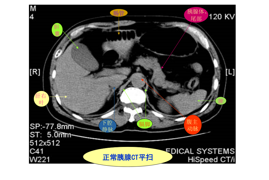 急性重症胰腺炎刘在绪.ppt_第3页