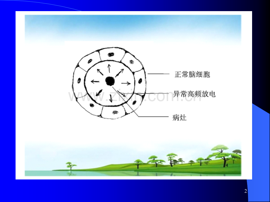 局限型癫痫的治疗措施ppt课件.ppt_第2页