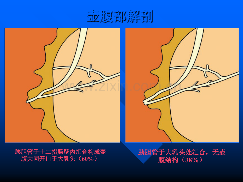 壶腹周围癌的影像诊断.ppt_第3页