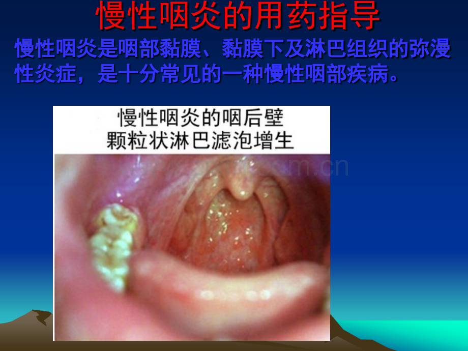 慢性咽炎的用药指导.ppt_第1页