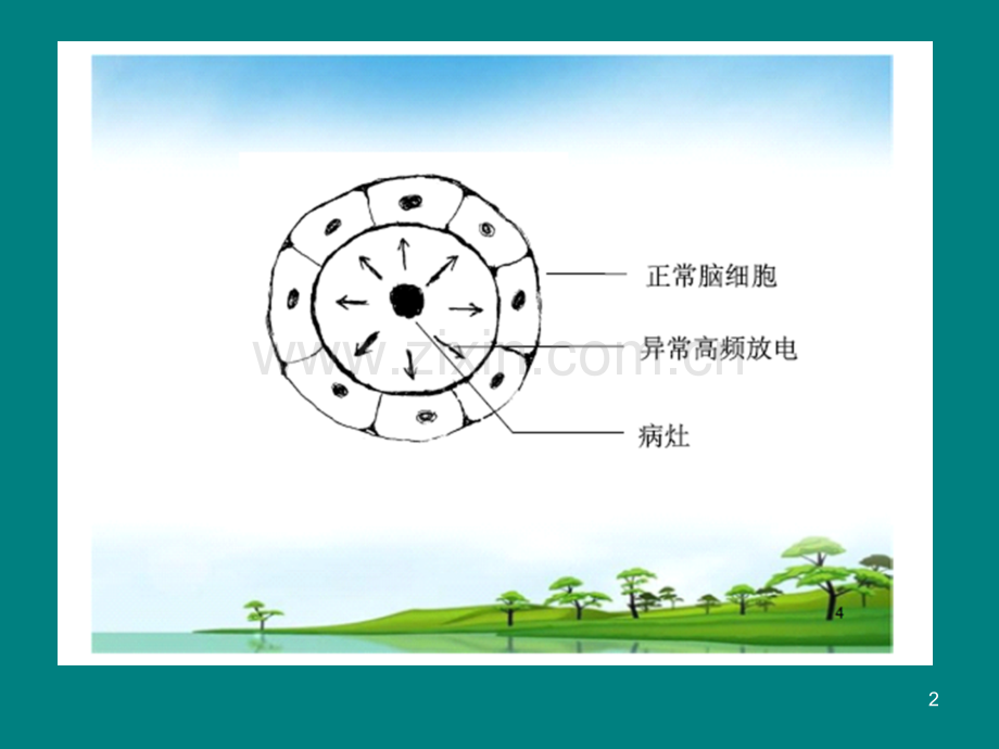 局限型癫痫的治疗措施.ppt_第2页