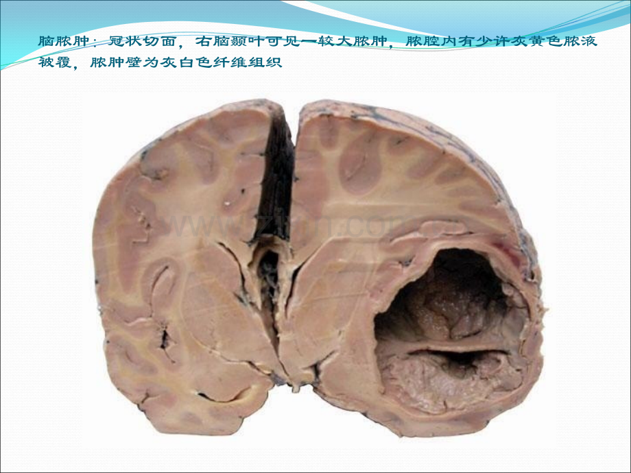 实验十神经系统病理实验.ppt_第3页