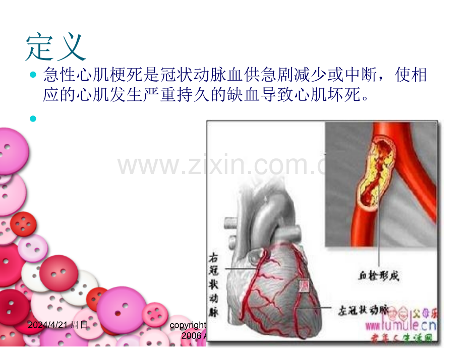 急性心梗护理.ppt_第3页