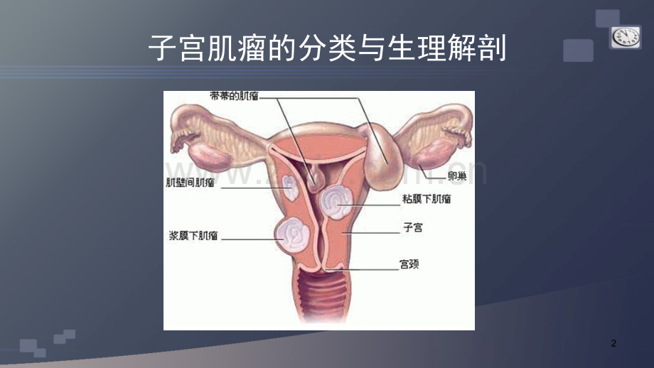 子宫肌瘤的护理查房.pptx_第2页