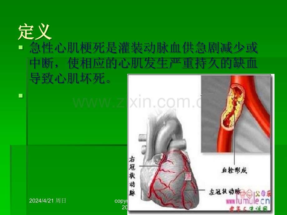 急性心肌梗死病人的护理.ppt_第3页