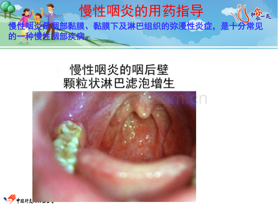 慢性咽炎的用药指导ppt课件.ppt_第1页