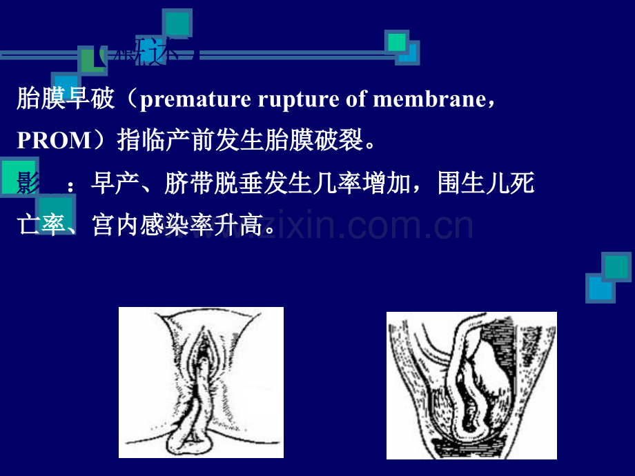 胎膜早破的护理.ppt_第2页