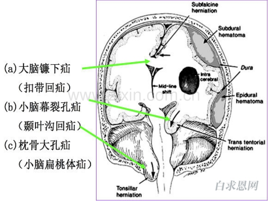 脑疝的临床表现与.ppt_第3页