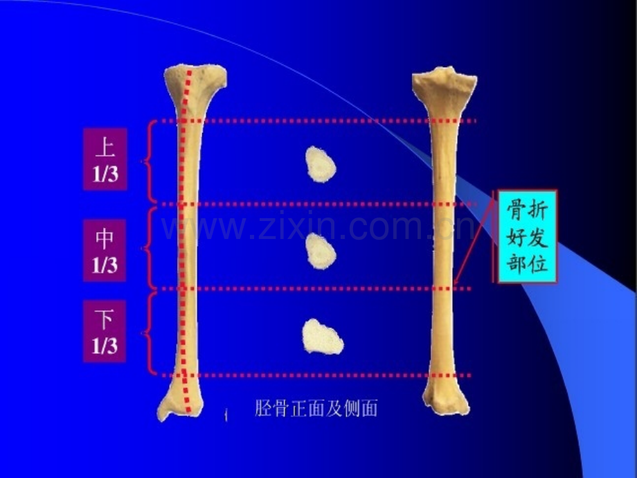 胫腓骨骨折课件.ppt_第3页