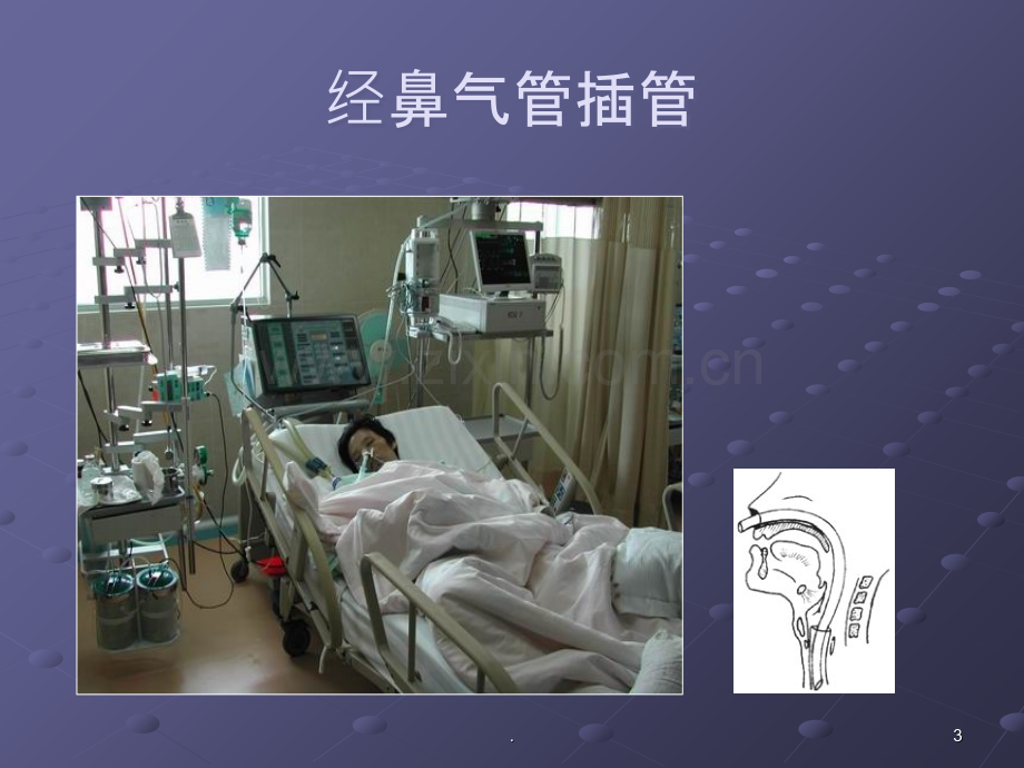 经鼻气管插管NTI.ppt_第3页