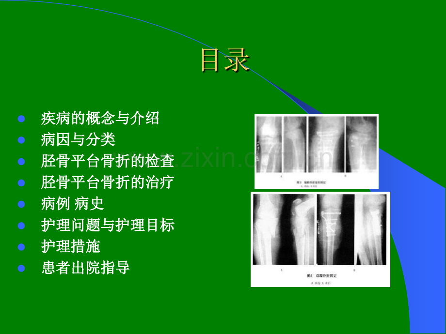 胫骨平台骨折的护理查房.ppt_第2页