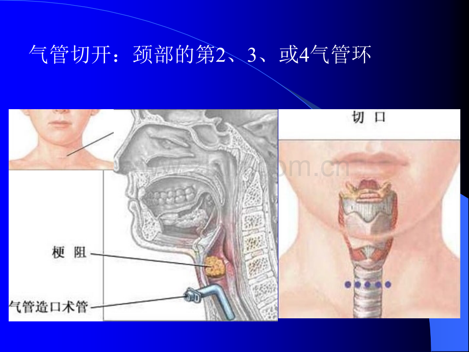 气管切开的术后护理.ppt_第3页