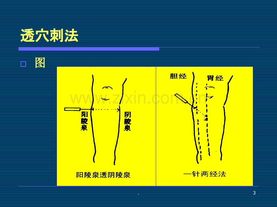 毫针刺法的临床应用-.ppt_第3页