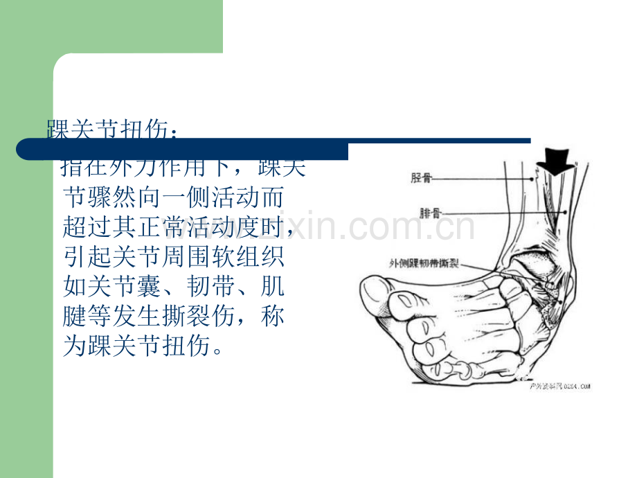 踝关节扭伤Sprainedankle.ppt_第2页