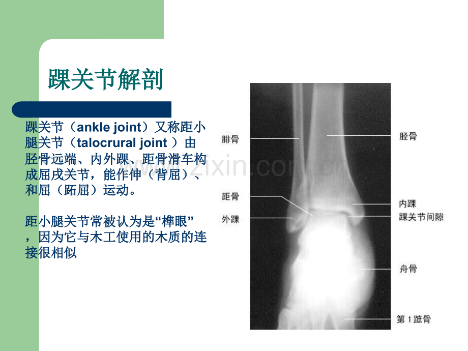 踝关节扭伤Sprainedankle.ppt_第3页