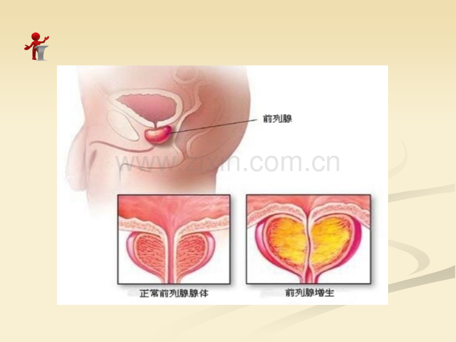 良性前列腺增生病人的护理.ppt_第3页