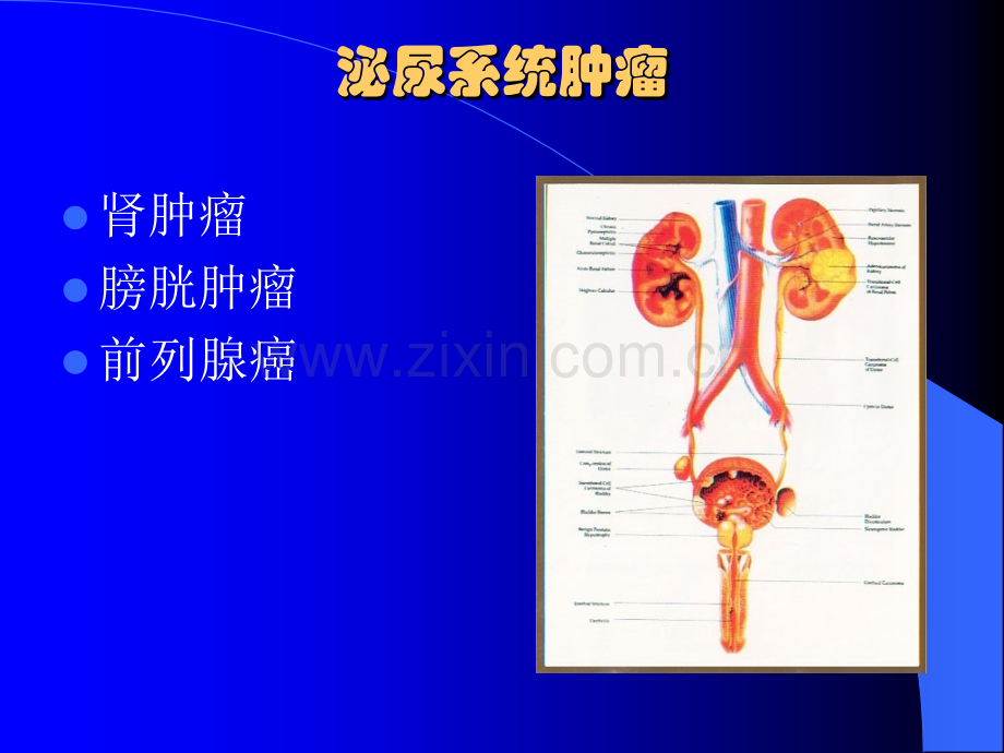 泌尿系统肿瘤-(3).ppt_第2页