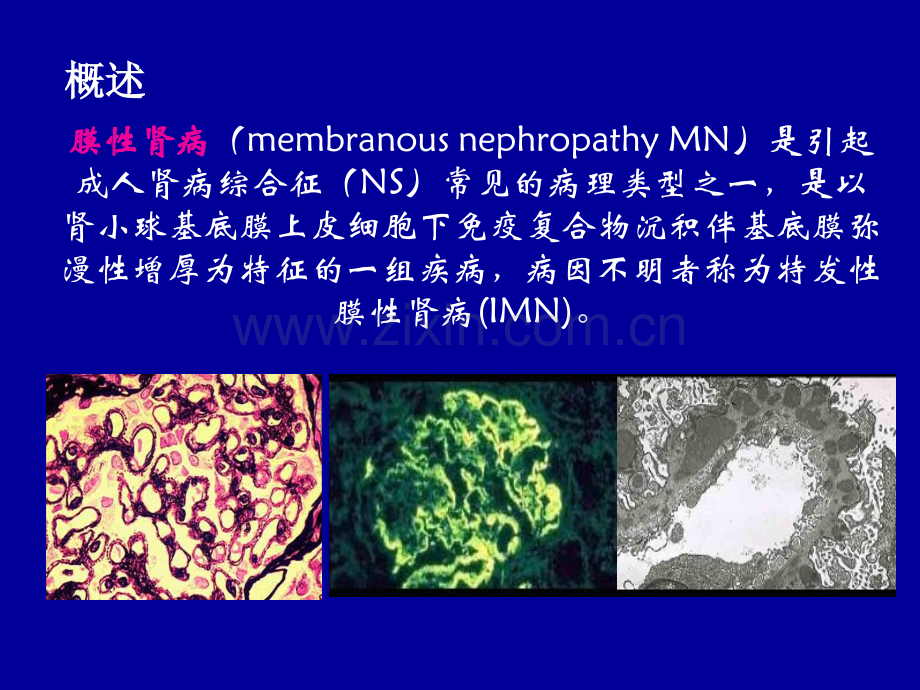 特发性膜性肾病ppt课件.ppt_第2页