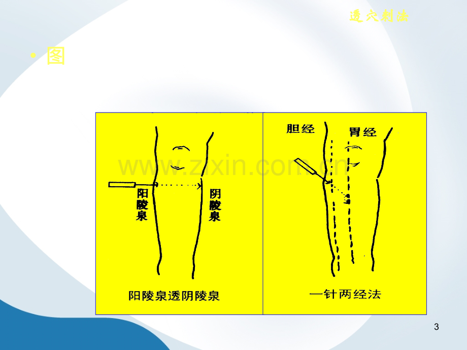 毫针刺法的临床应用.ppt_第3页