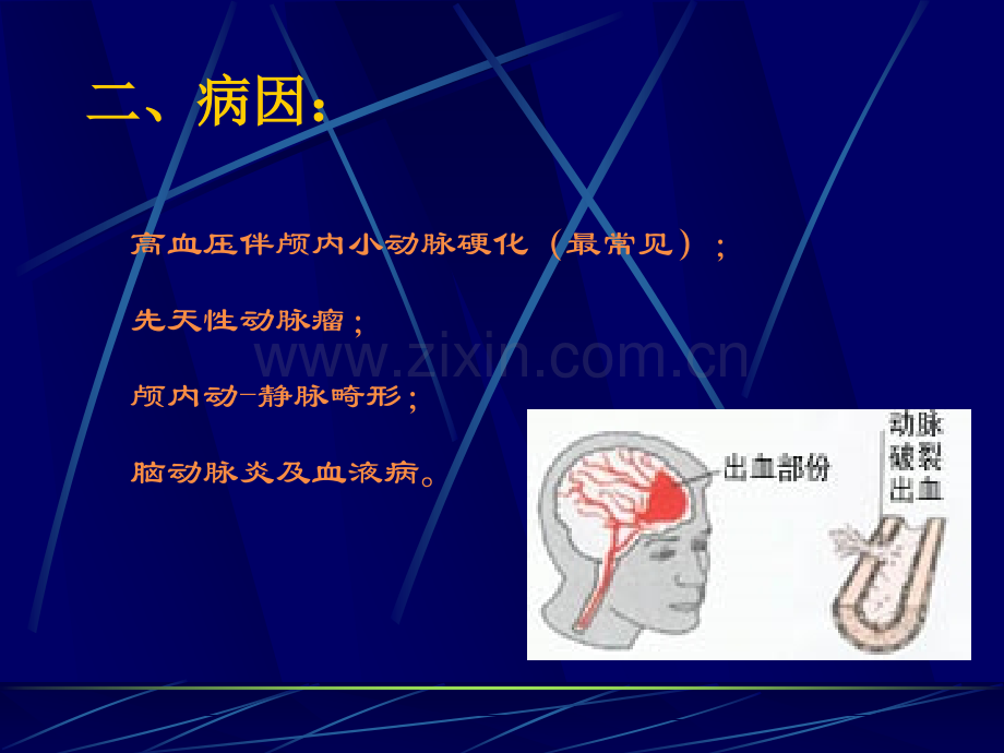 脑出血业务学习PPT.ppt_第3页