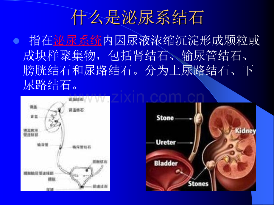 结石病人的饮食指导.ppt_第3页