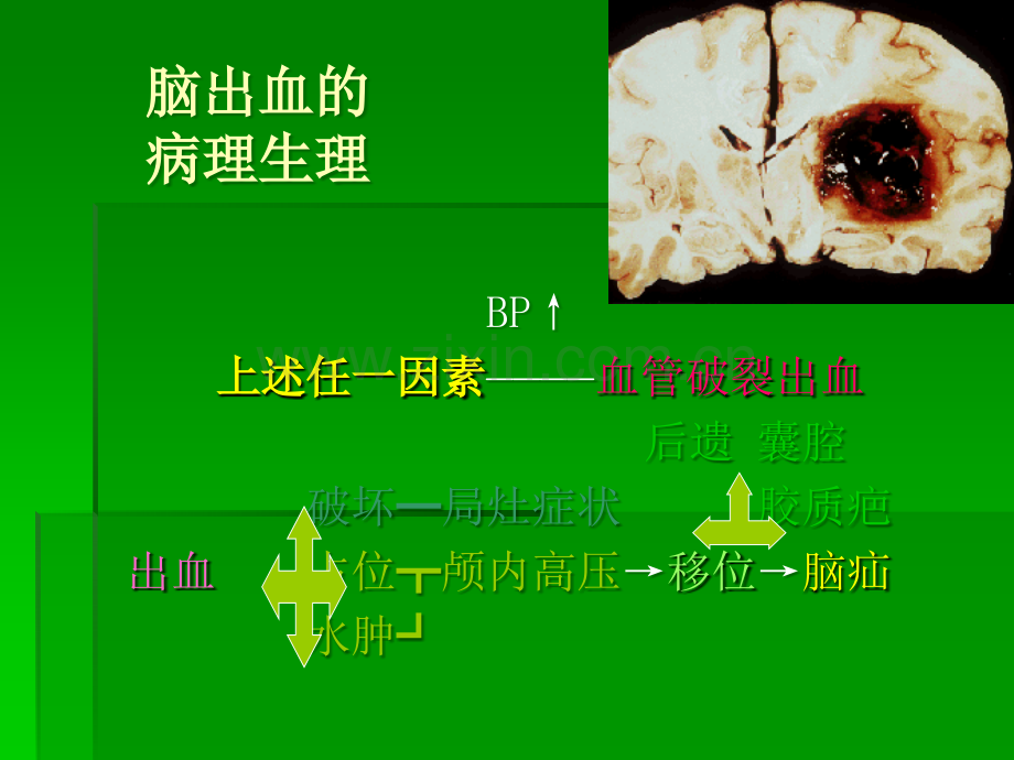 脑出血教案.ppt_第2页