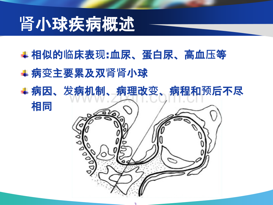 肾小球肾炎病人的护理.ppt_第3页