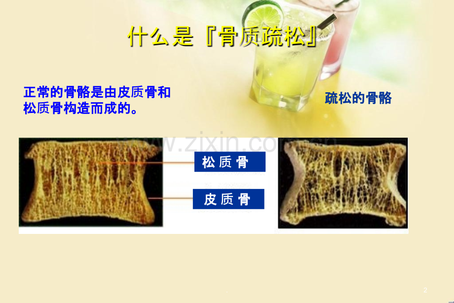 老年骨质疏松的健康指导.ppt_第2页