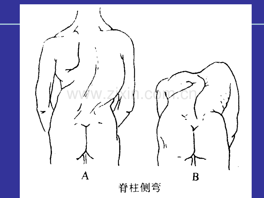 脊柱脊髓损伤的体格检查.ppt_第3页