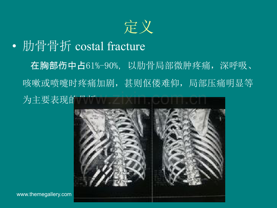 肋骨骨折的影像学表现.ppt_第2页