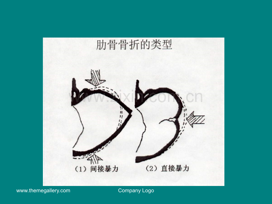 肋骨骨折的影像学表现.ppt_第3页