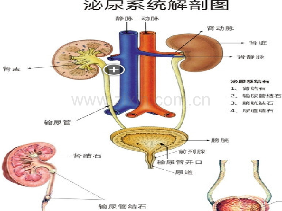 泌尿外科常见疾病的护理1.ppt_第3页