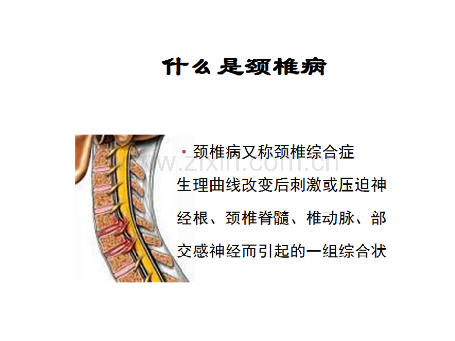 专家图解颈椎病的预防与保健.pptx_第2页