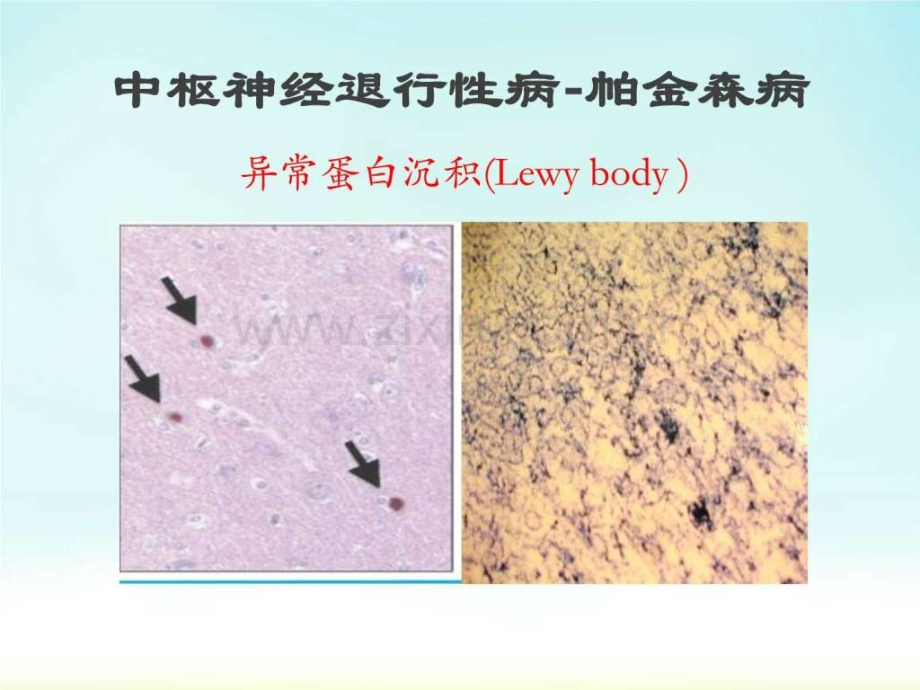 帕金森1生物学自然科学专业资料.pptx_第3页