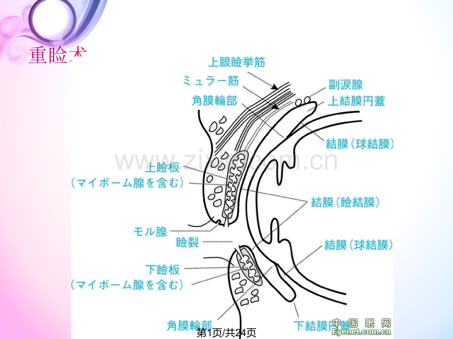 不开刀变双眼皮方式.pptx_第1页