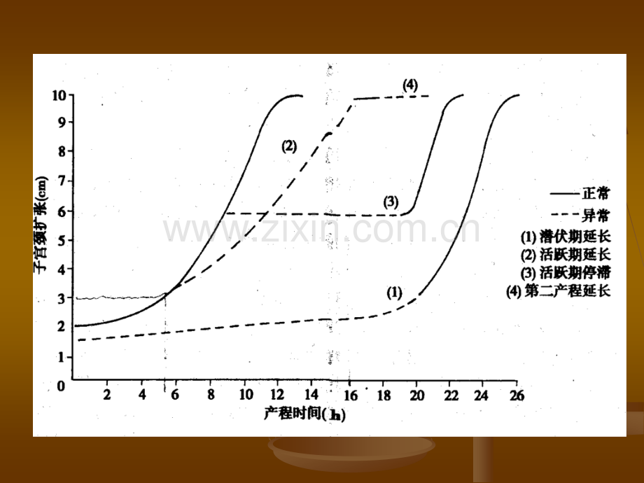 临床表现协调性宫缩乏力.pptx_第3页