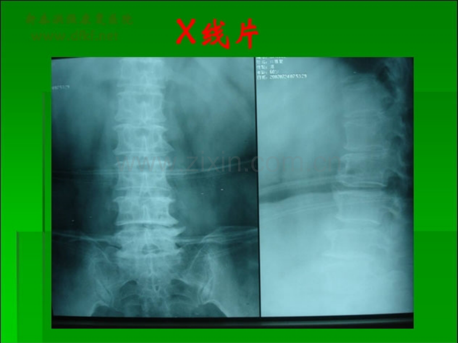 针刀治疗椎管狭窄症.pptx_第2页