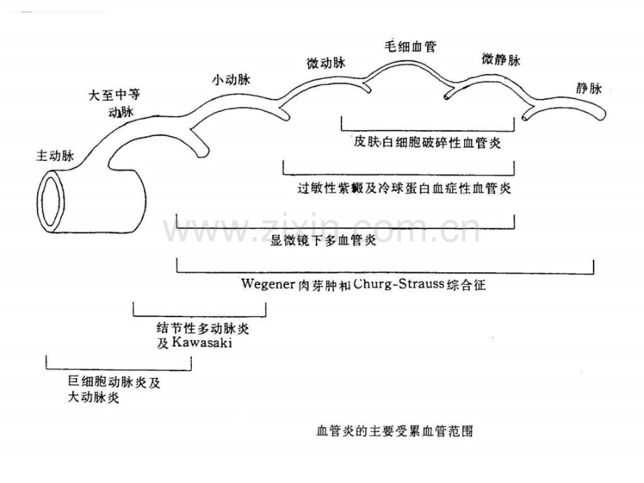 ANCA相关性血管炎的诊治进展.pptx_第2页