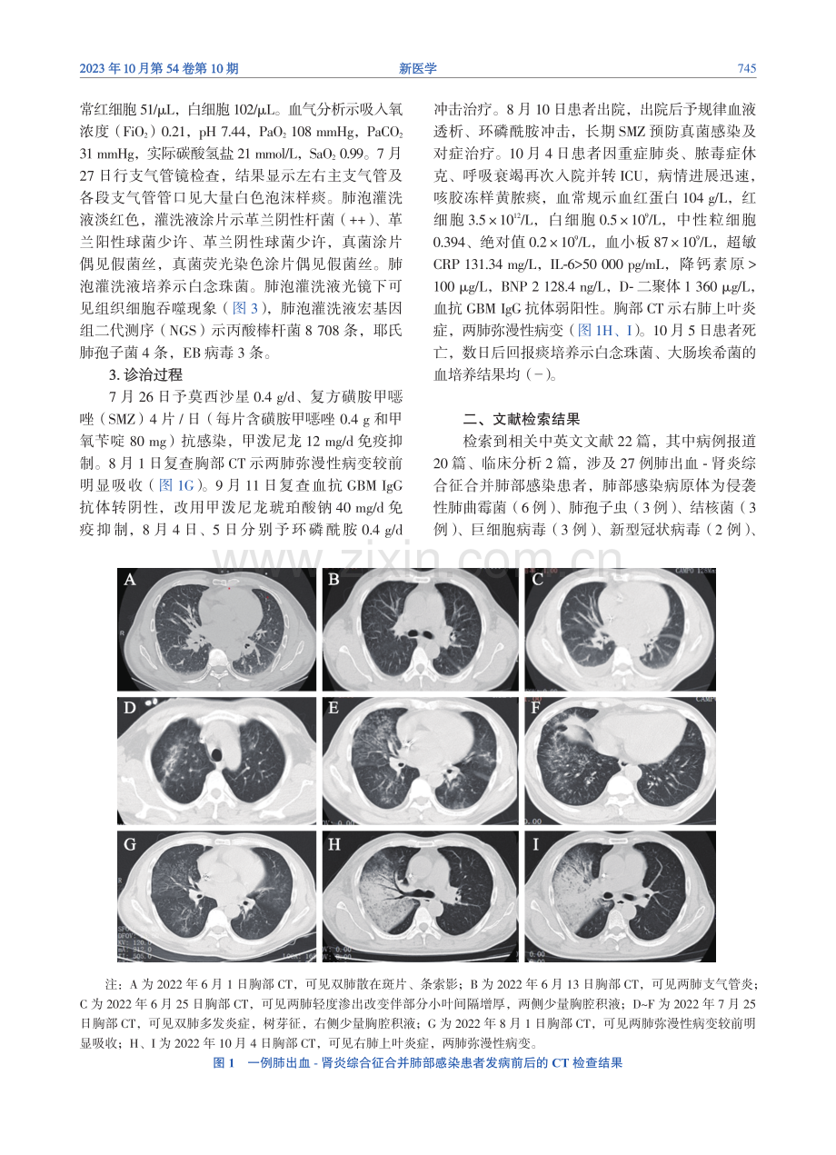 肺出血-肾炎综合征合并肺部感染一例并文献复习.pdf_第3页