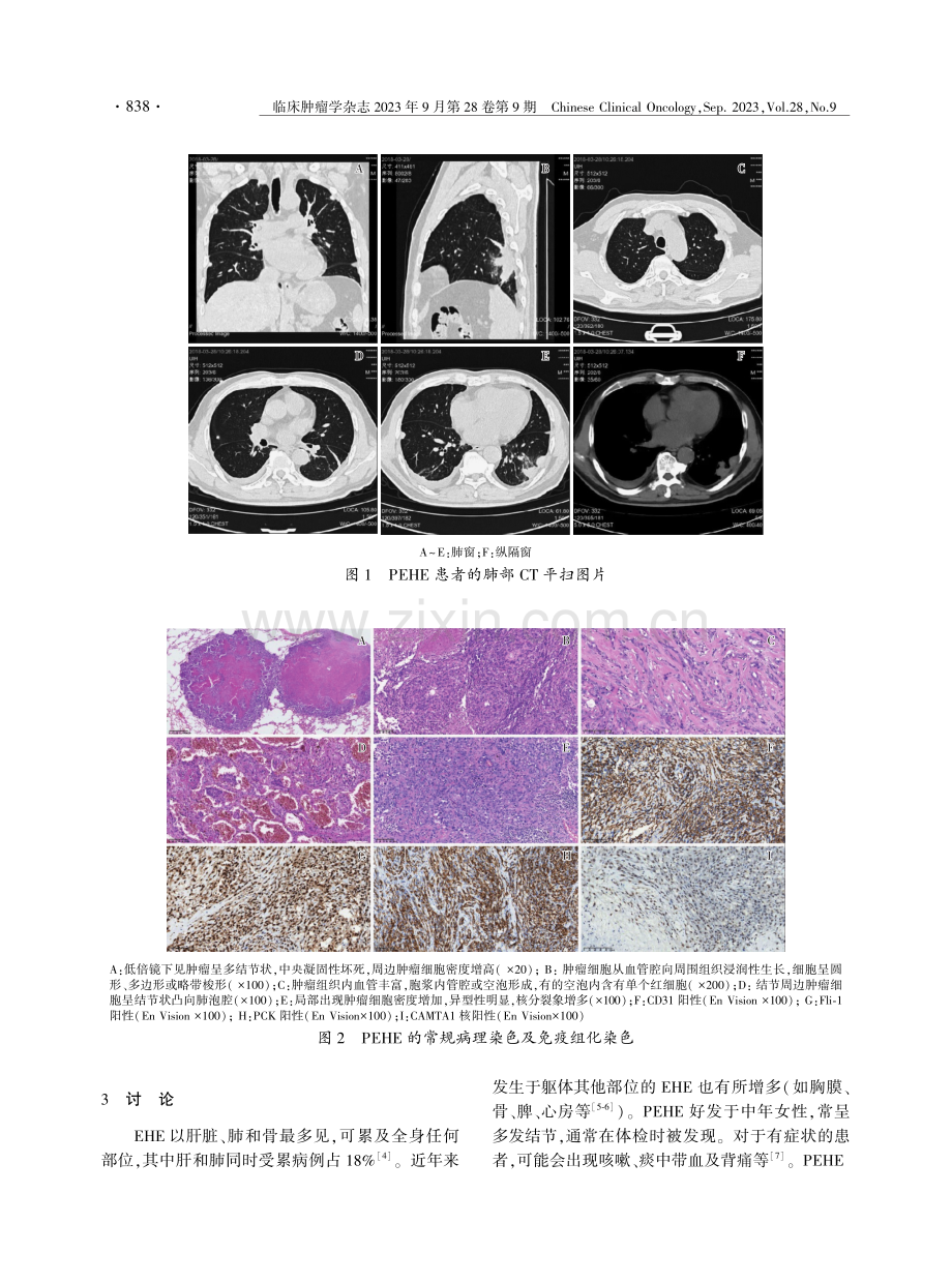 肺上皮样血管内皮瘤4例临床病理观察.pdf_第3页