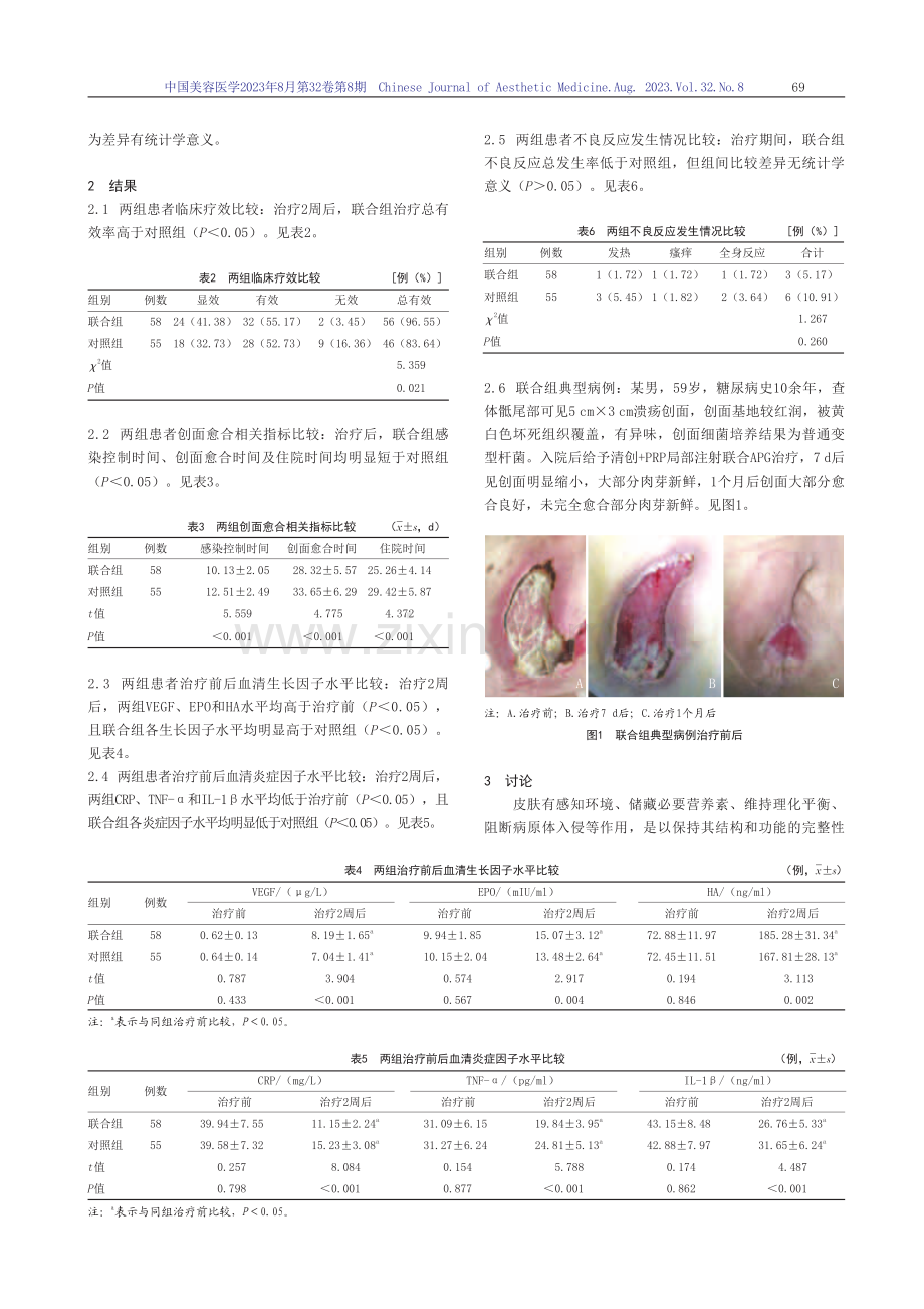 富血小板血浆局部注射联合血小板凝胶覆盖治疗慢性难愈性创面.pdf_第3页